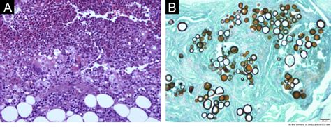 Severe Paracoccidioidomycosis With A Fatal Outcome And Incidence