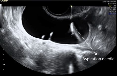 Chapter 12 Operative Ultrasound In Gynaecology Obgyn Key