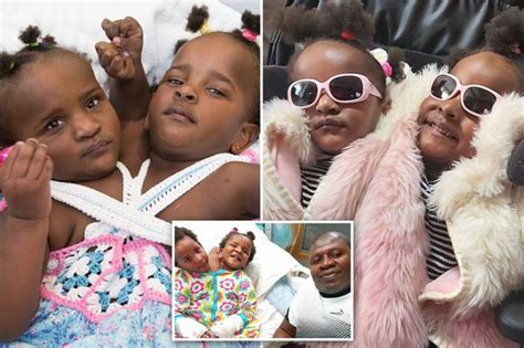 Conjoined Twins Miracle Survival After They Are Born Sharing Chest And
