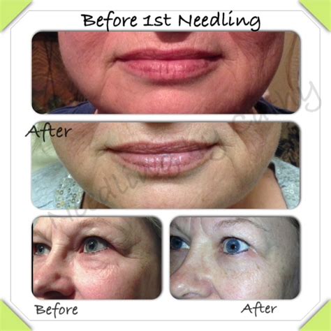 I thought my days of looking young were long gone. Adorably Ageless - Microneedling for Skin Rejuvenation and ...