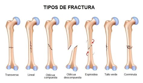 Diferencia Entre Fisura ósea Y Fractura De Hueso