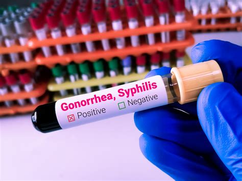 Gonorrhoea Syphilis On Rise In England Health Agency Easterneye