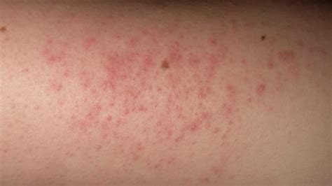 Itchy Raised Skin Bumps On Legs Sexiz Pix