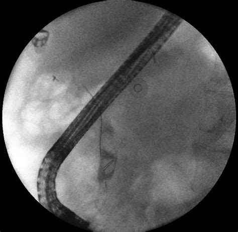 Ercp Cholangiogram Of The Same Patient Showing A Bile Duct Stone Formed