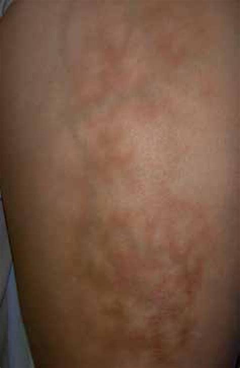 Scielo Brasil Laptop Computer Induced Erythema Ab Igne A New