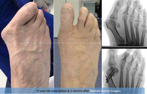 Cosmetic Foot Surgery Australia Kicosmetic