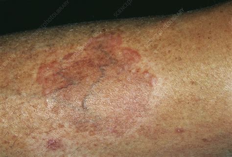 Skin Lesions Stock Image M1650214 Science Photo Library