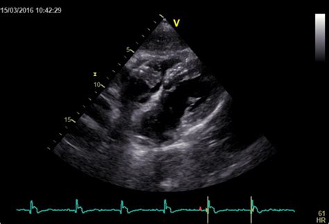 Figure 1 Trans Thoracic Cardiac Ultrasound Showing A Huge Vegetation
