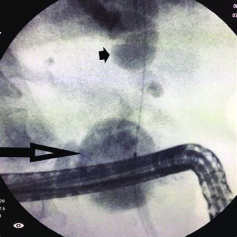 A 58 Year Old Male Patient Presented With Obstructive Jaundice Due To