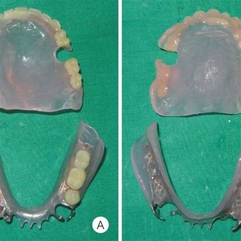 Fabrication Of Open Faced Maxillary Overdenture And Mandibular Cast