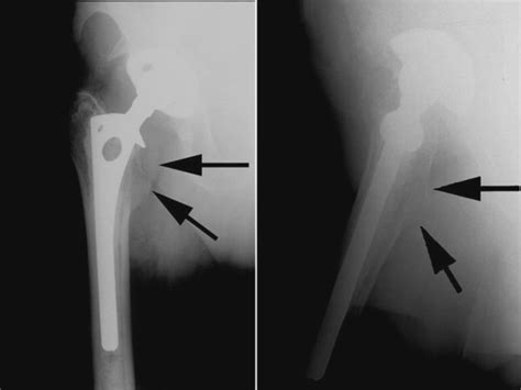 Rupture Of The Ilio Psoas Tendon After A Total Hip Arthroplasty An