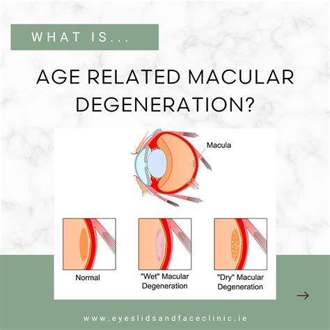 Age Related Macular Degeneration Eyes Lids And Face Clinic