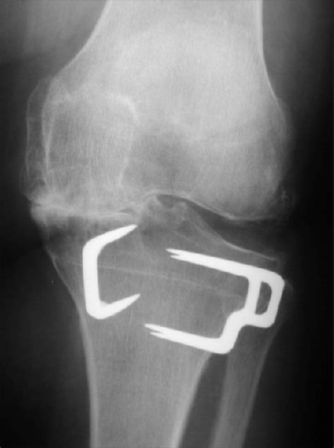 Anteroposterior Radiograph Of The Proximal Tibial Metaphysis After High