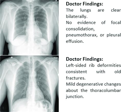 Examples Of Chest X Ray Images And Radiology Reports Download