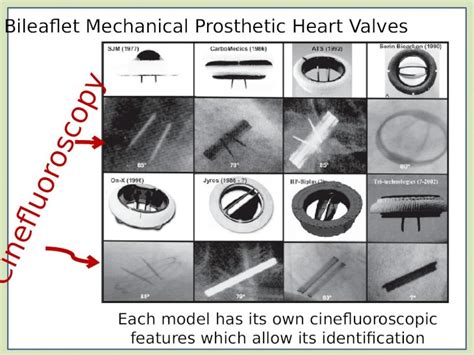 Role Of Cinefluoroscopy In Prosthetic Valve Disease Pptx Powerpoint