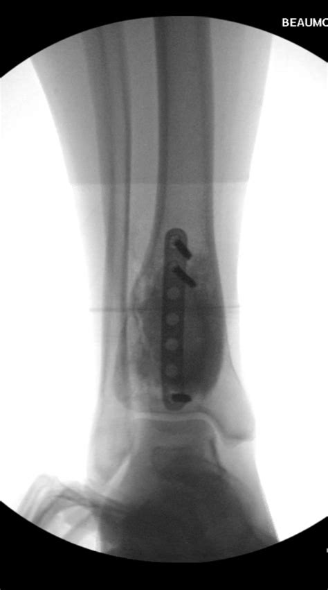 Expansive Unicameral Bone Cyst Occupying The Distal Tibia A Case