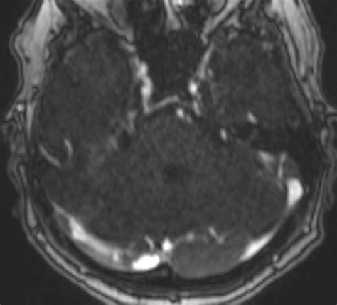 Dural Venous Sinus Thrombosis Neuro Mr Case Studies Ctisus Ct Scanning