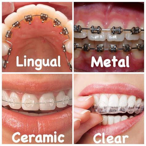 Types Of Orthodontic Appliances Dentaldelrioalgodones