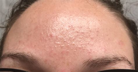 Help My Forehead Is Constantly Textured Like This For As Long As I Can