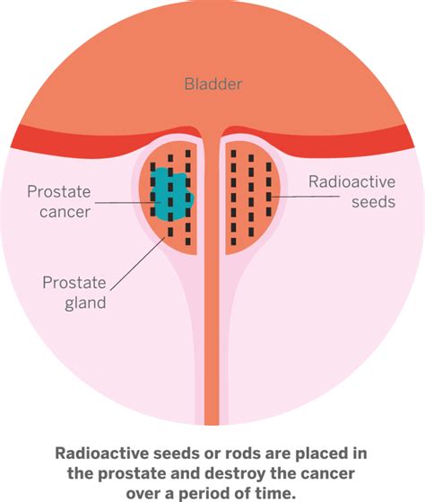 Radical Radiotherapy Prostate Cancer Research