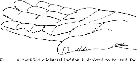 Figure 1 From A Modified Midlateral Incision For Volar Approach To The