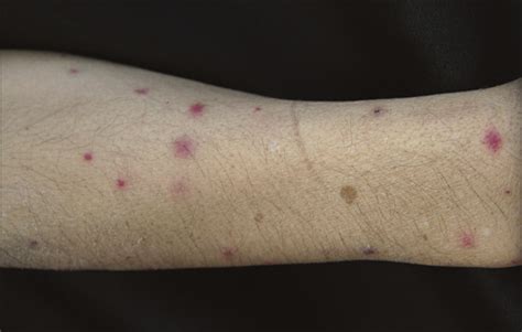 Generalized Papules In A Patient With Acute Myeloid Leukemia—quiz Case