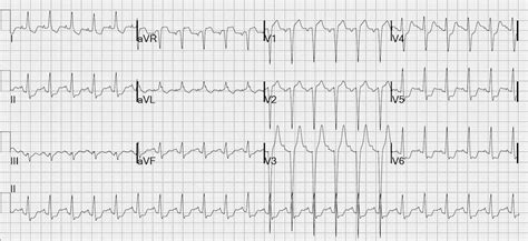 St Elevation In Avr Litfl Ecg Library Diagnosis