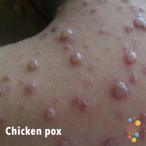 Chicken Pox Pictures In Adults