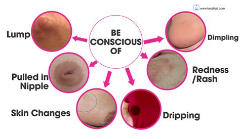 Irritation or dimpling of breast skin. Kanker Payudara: Gejala, Penyebab, dan Pengobatan - KeyPoo ...