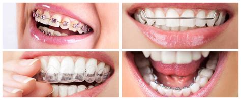 Ortodoncia Dentaristo
