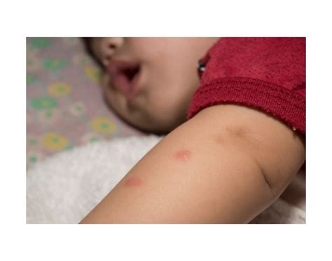 Punture Di Zanzare Nei Bambini Cura E Prevenzione