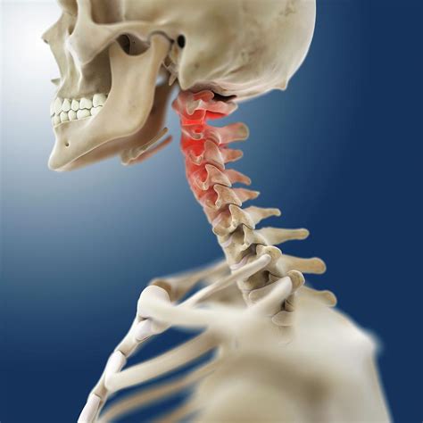 Neck Pain Photograph By Springer Medizinscience Photo Library