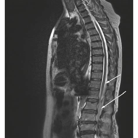 Axial MRI Slice At Initial Presentation Contrast Enhanced T1 Weighted