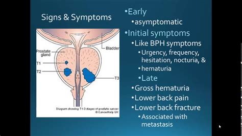 Male Reproductive Cancers Youtube