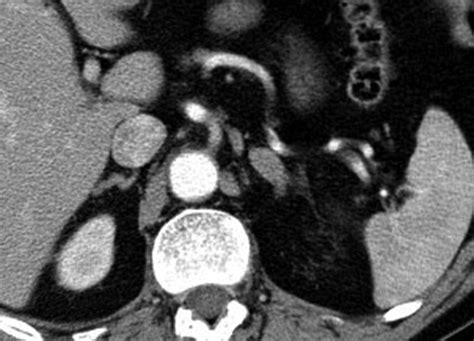 Morphologic Features Of 211 Adrenal Masses At Initial Contrast Enhanced