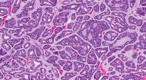 Adenoid Cystic Carcinoma Atlas Of Pathology