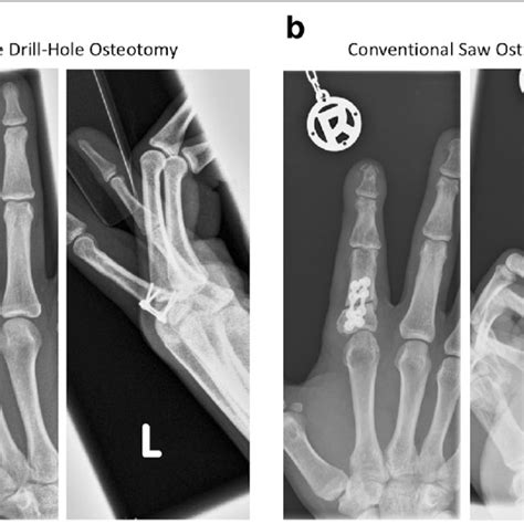 Comparison Of Multiple Drill Hole Osteotomy A And Conventional Saw
