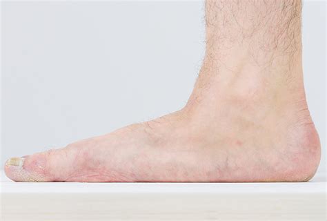 Flatfoot Surgery Procedure Risks And Recovery Emedihealth