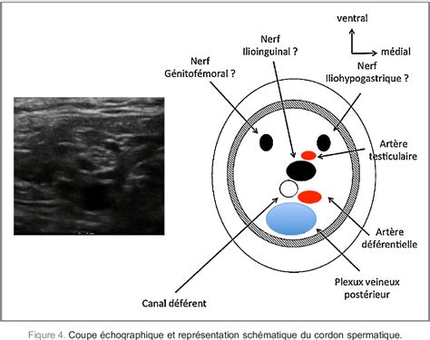 Cordon Spermatique Du Nerf Ilio Inguinal