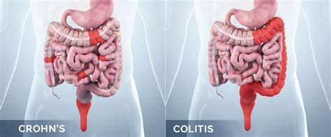 What Is The Difference Between Crohns Disease And Ulcerative Colitis