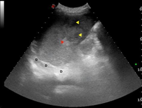 Ruptured Spleen Ultrasound