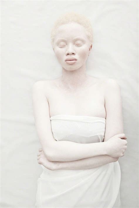 Justin Dingwall Vulnerable Eyes Closed Lizamore And Associates Albinism