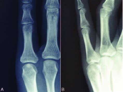 Postoperative Radiographs A Oblique And B Lateral Radiographs Of Download Scientific