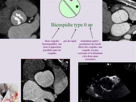 Ppt Aortic Bicuspid Valve In Flight Crew Case Reports And Aeromedical Fitness Powerpoint