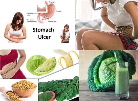 Stomach Ulcers Gastric Ulcer Causes Symptoms Natural Remedies And