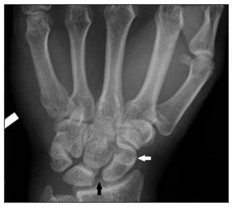 Image Diagnosis Scapholunate Dissociation The Permanente Journal