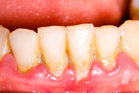Receding Gums Its Causes And Treatment Oramd