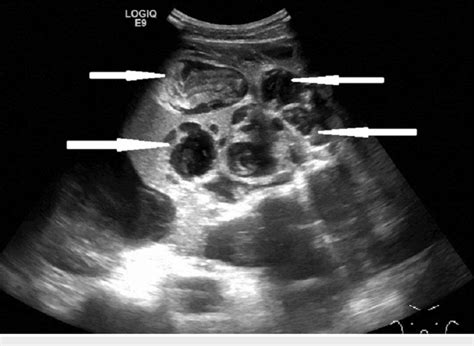 Ultrasound Of Abdomen Showing Multiloculated Ascites With Extensive