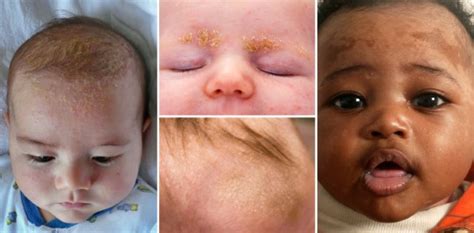 Cradle Cap What It Is And What You Can Do About It Dose Of Greens