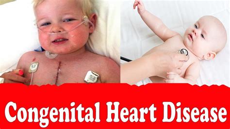 Congenital Heart Defects Symptoms
